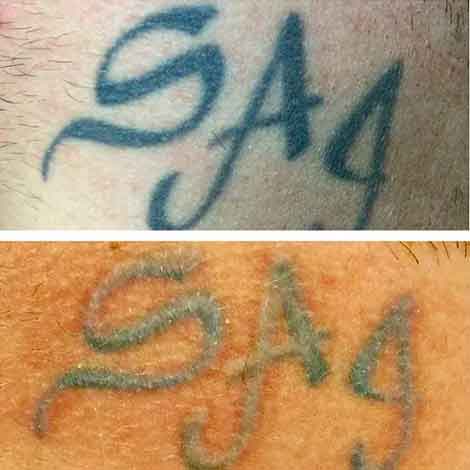 Tattoo and Tattoo Removal Services